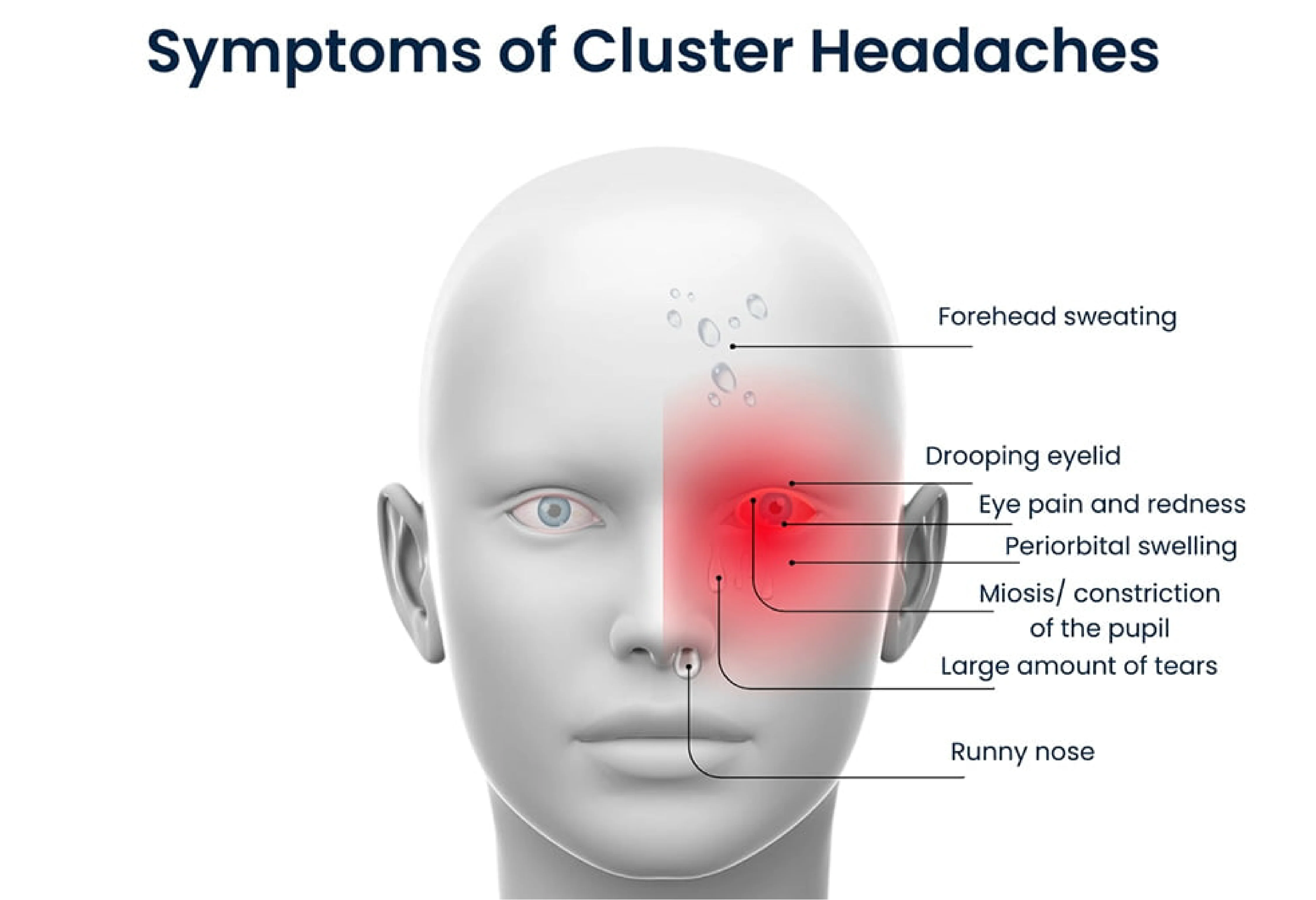 Cluster Headaches Causes, Symptoms, and Treatment